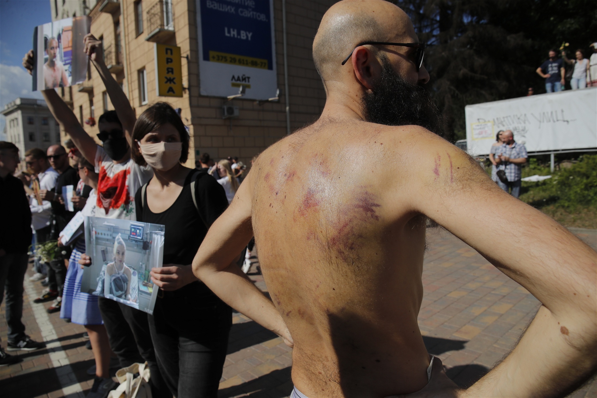 En demonstrant som varit gripen men släppts visar upp sina skador vid en demonstration i Minsk den 15 augusti. Foto: Dmitri Lovetsky